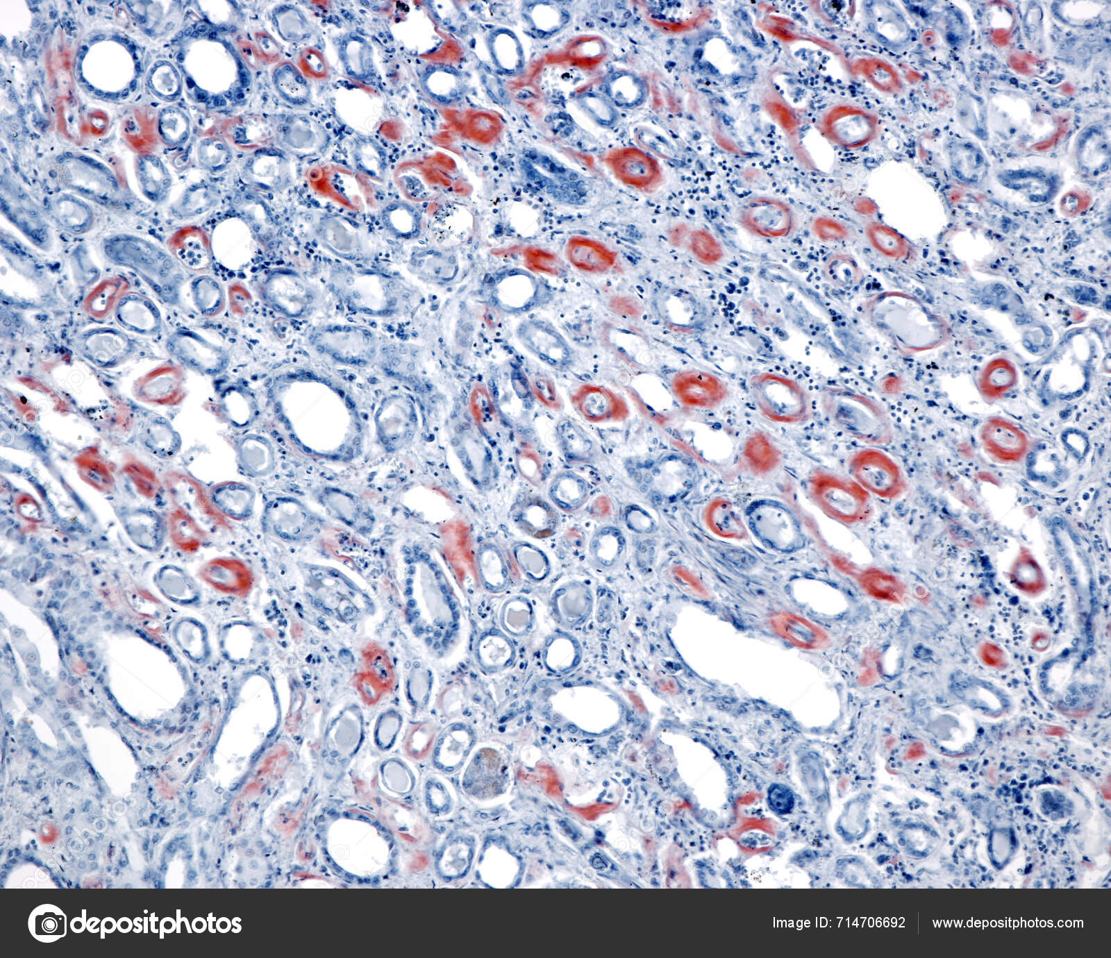 Amyloid“-Fibrillen im Fettgewebe