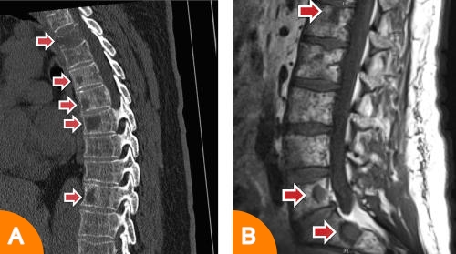 athologische CT und MRT Veränderungen beim multiplen Myelom