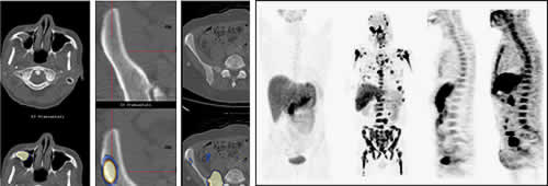 Darstellung von Myelommanifestationen mittels PET/CT